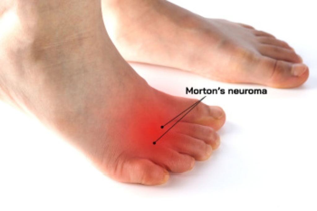 Definition and Risk Factors of Morton’s Neuroma