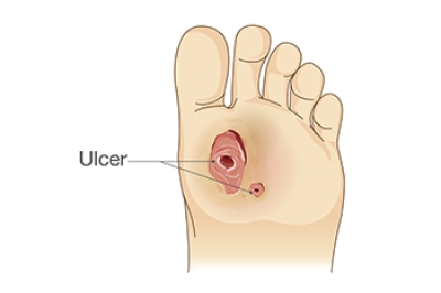 Foot Complications From Diabetes