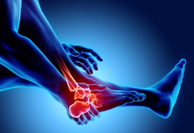 Finding Relief for Foot Arthritis