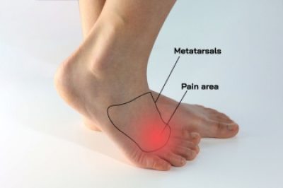 Causes and Risk Factors of Morton’s Neuroma